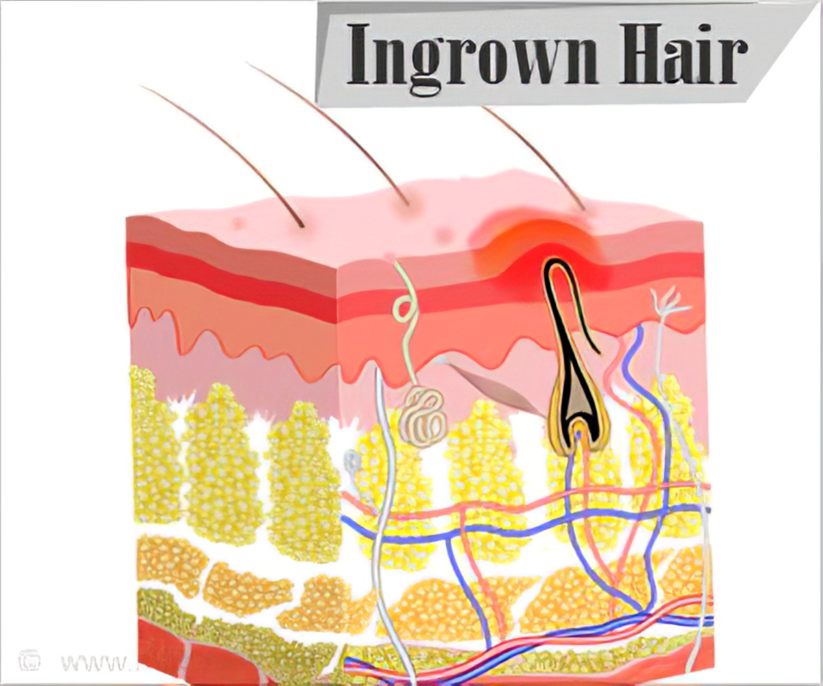 Infected ingrown bikini hair