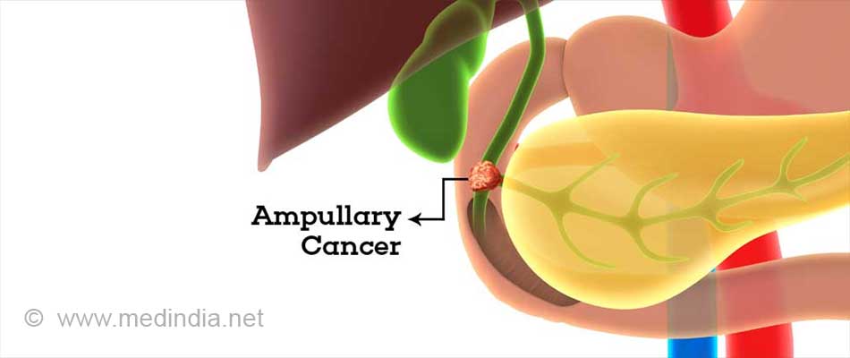 Ampullary Cancer Causes Symptoms Diagnosis Treatment