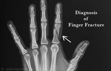 Fracture Of Finger Broken Finger Types Causes Symptoms Diagnosis