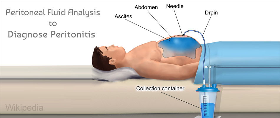 Peritonitis Causes Symptoms Complications Diagnosis Treatment Prevention