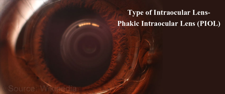 Intraocular Lens Implants IOL Types Procedure Recovery