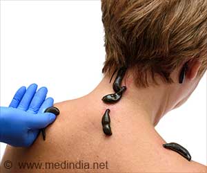 How Leeches Are Healing Modern Ailments