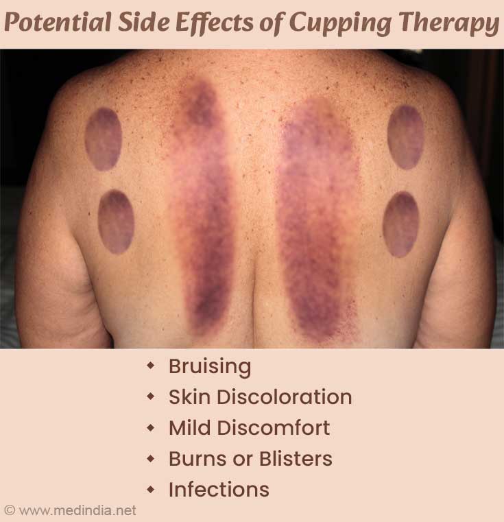 Potential Side Effects of Cupping Therapy