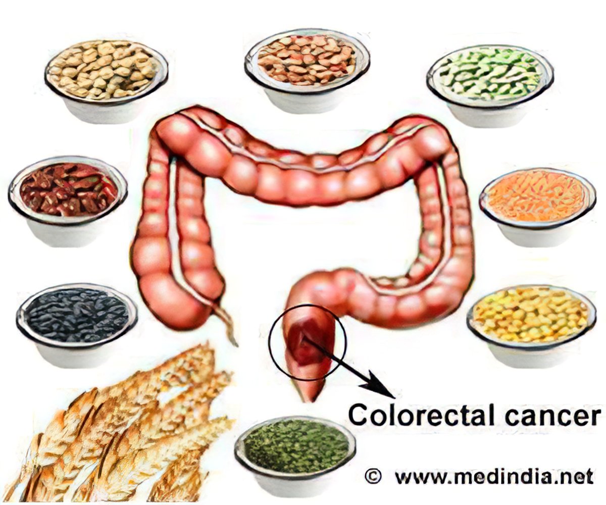 Colorectal cancer and nutrition