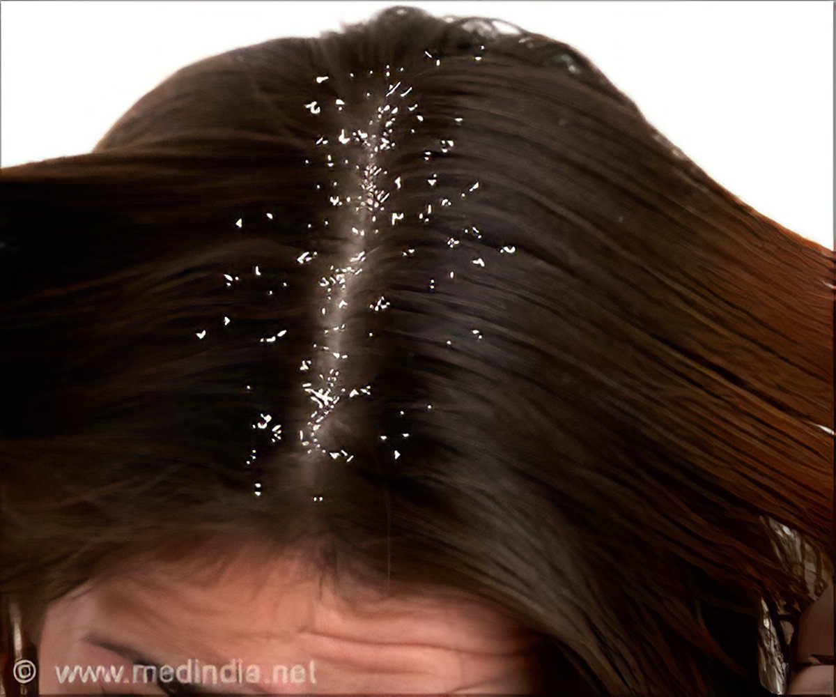 What Causes Dandruff? The Truth Behind Common Dandruff Myths SELF ...