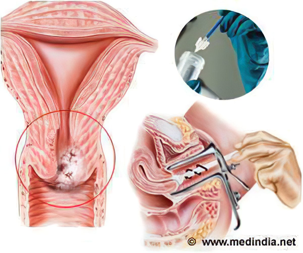 hpv womb cancer