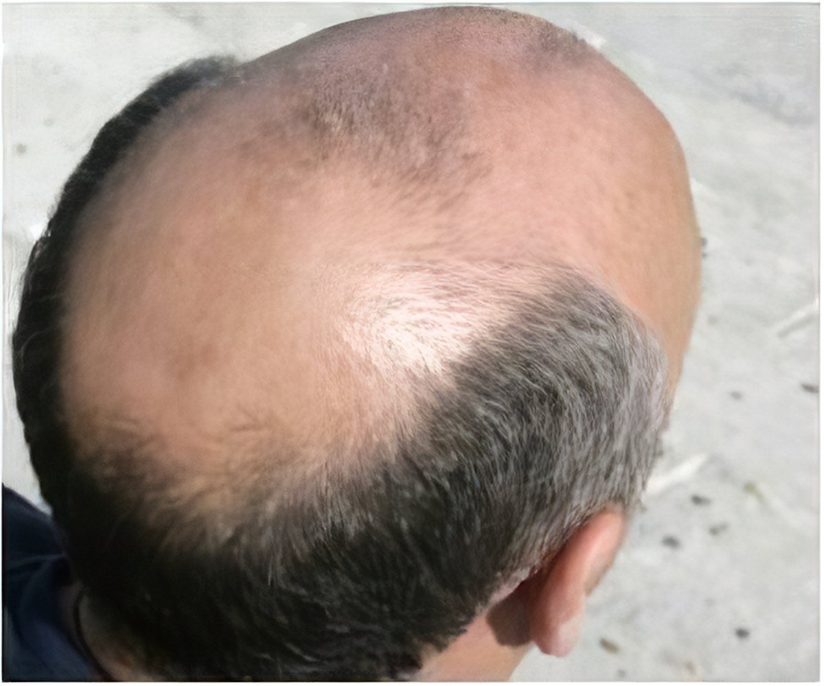 Rare Skin Disease and Male Pattern Baldness Share Genetic Link