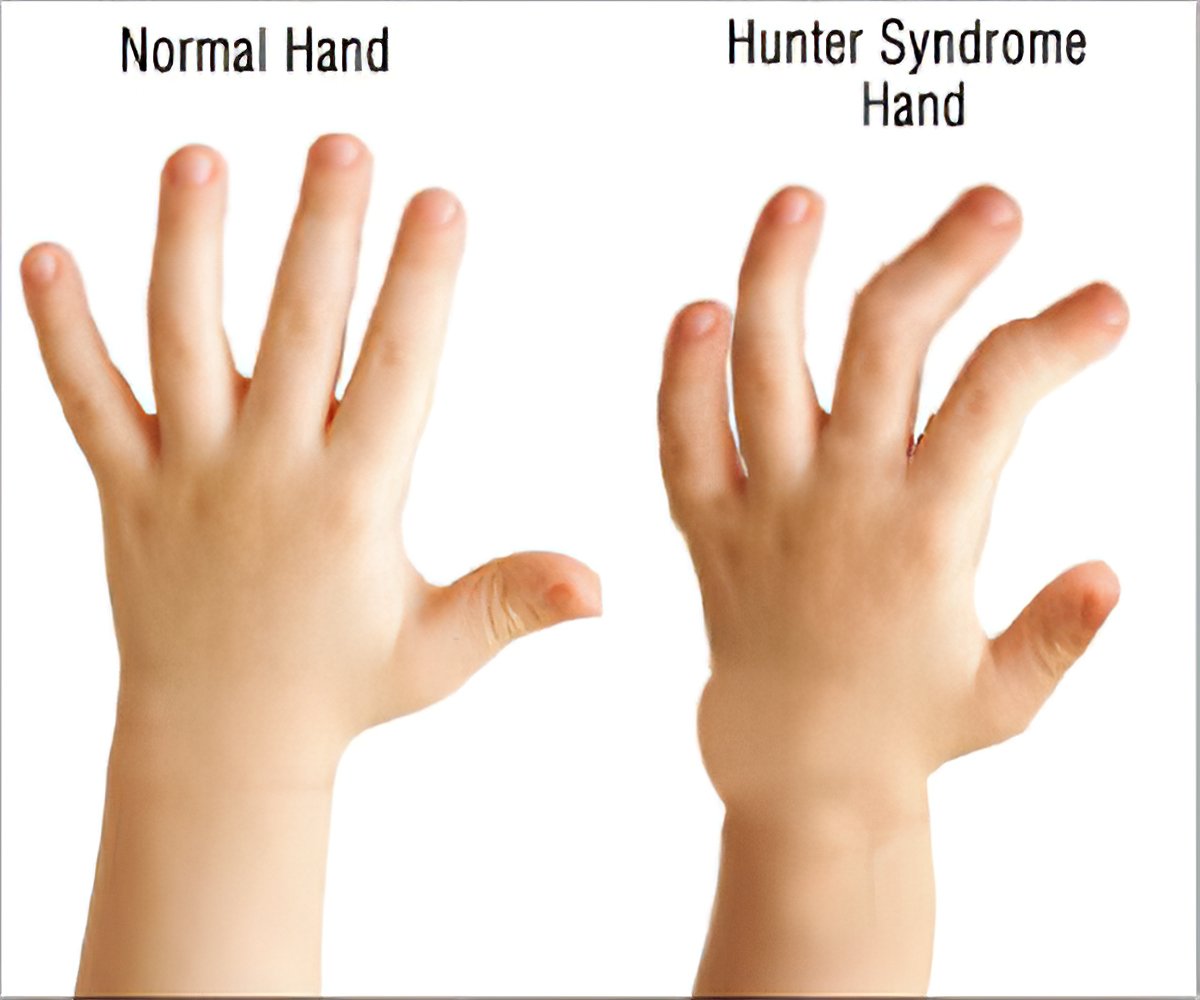 hunters syndrome