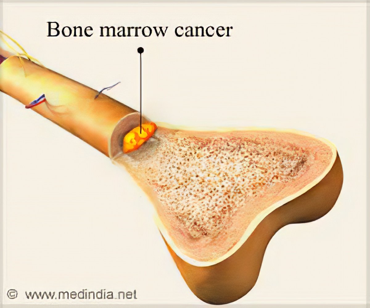 Immunotherapy To Treat Bone Marrow Cancer 