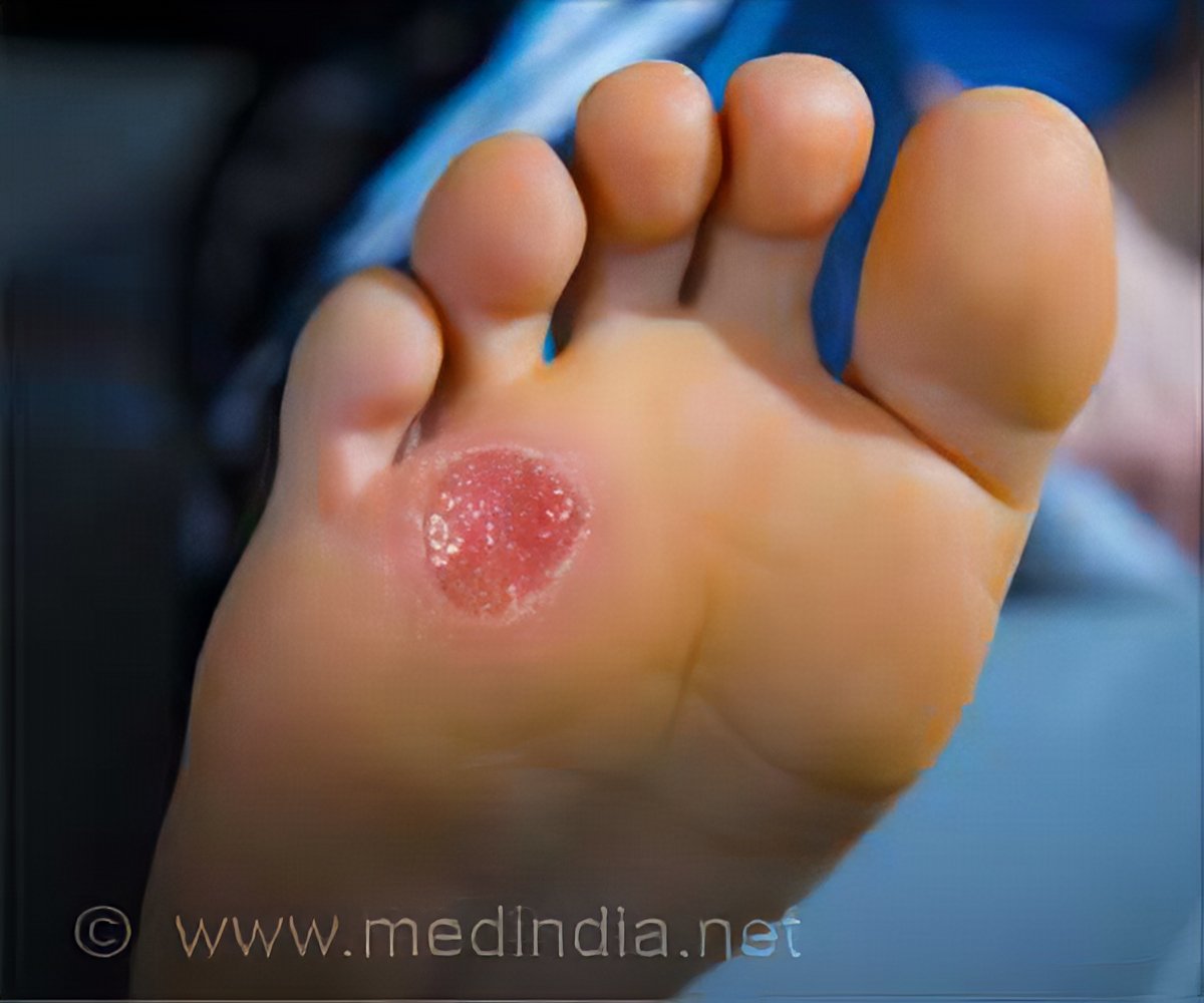 Diabetic Foot Ulcer Classifications: Wagner Scale & the UT System WCEI