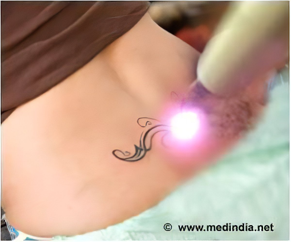 Permamant Laser Tattoo Removal Clinic in Gurgaon  Treatment Cost