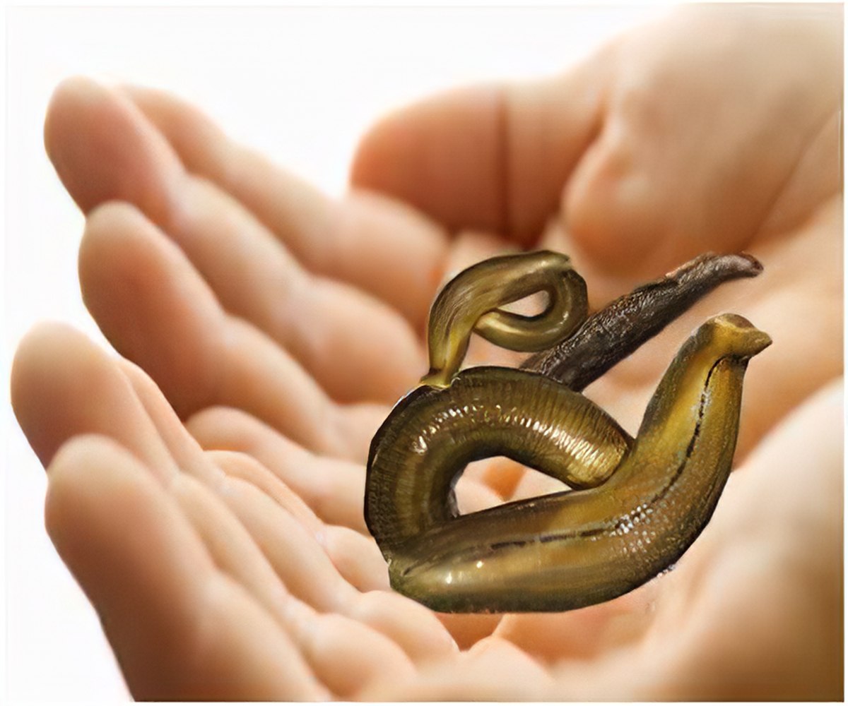 Leech Therapy Relieves Arthritis, Chronic Headaches and More