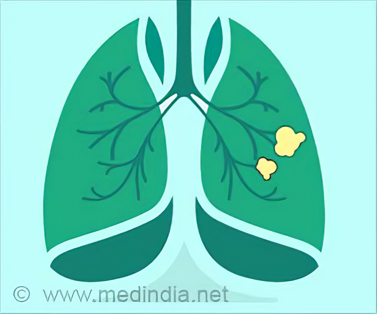 mesothelioma miracle cure
