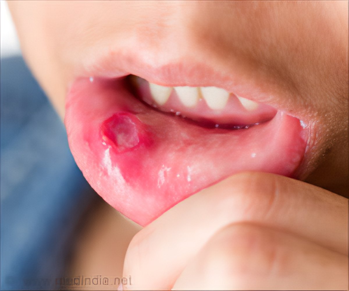 علت زخم های دهان و راه های درمان آنها