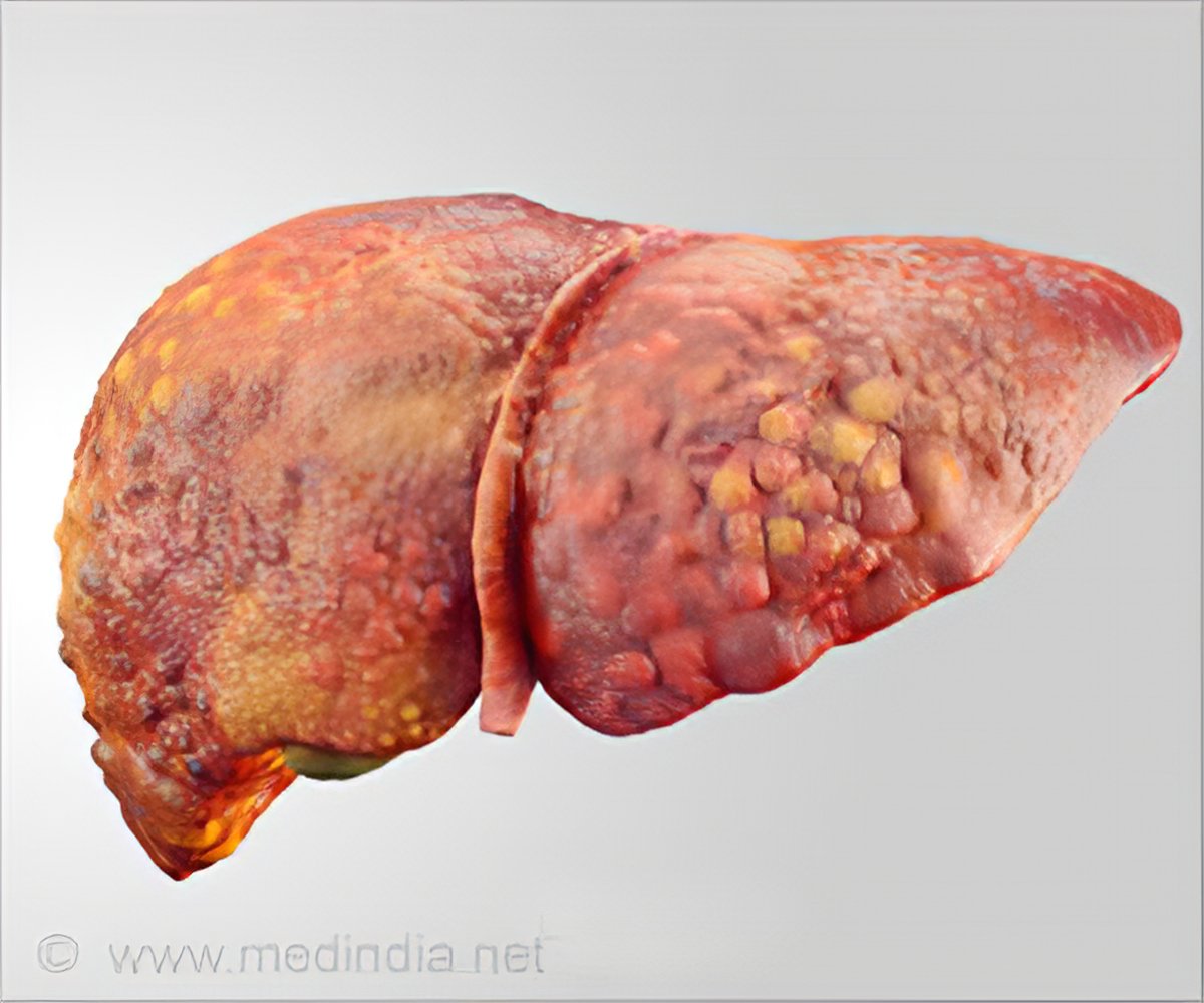 fatty liver and normal liver