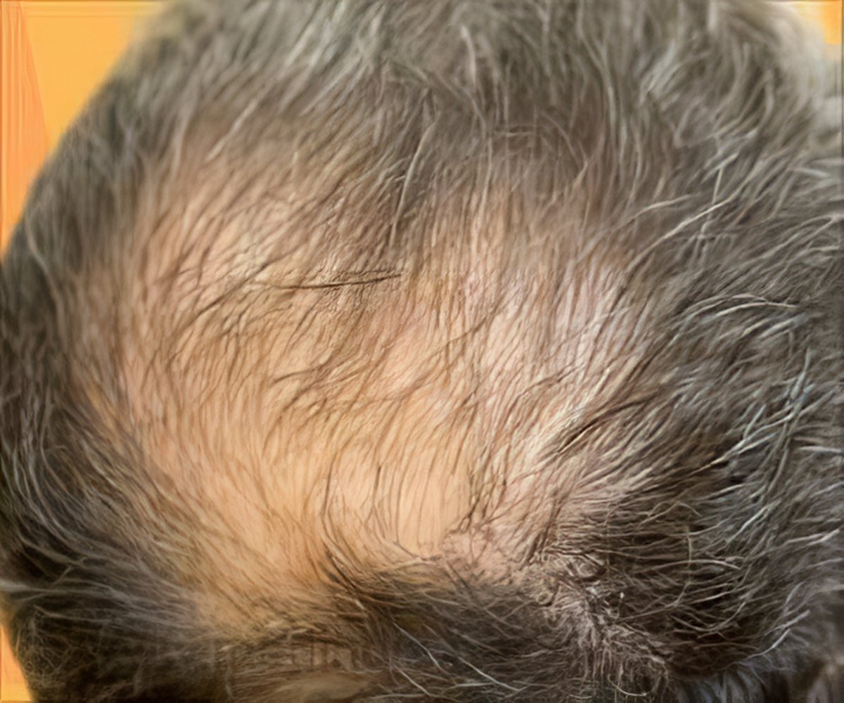 Novel Gene Responsible for Rare Form of Hair Loss Identified