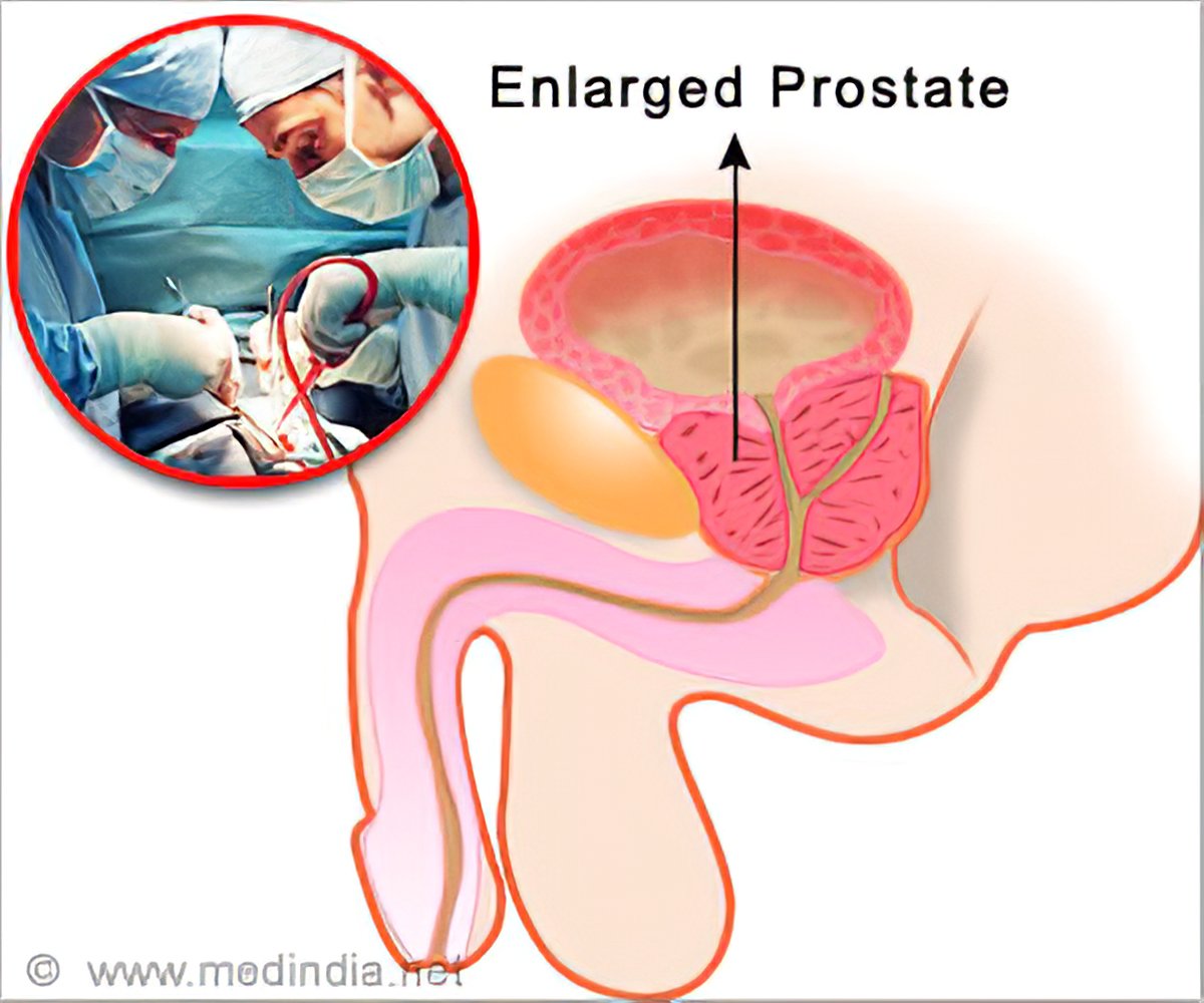 Prostatakrebs bilder