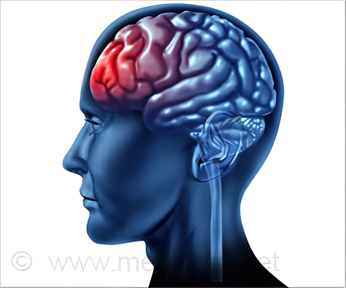 Long-term Multidomain Patterns of Change After Traumatic Brain Injury