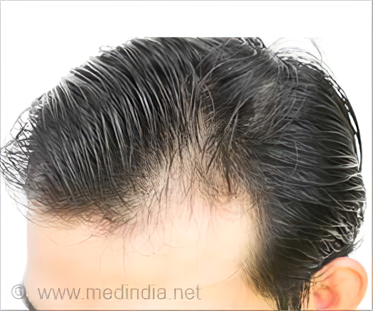 New Pill Causes Hair Regrowth in 40% Men With Alopecia