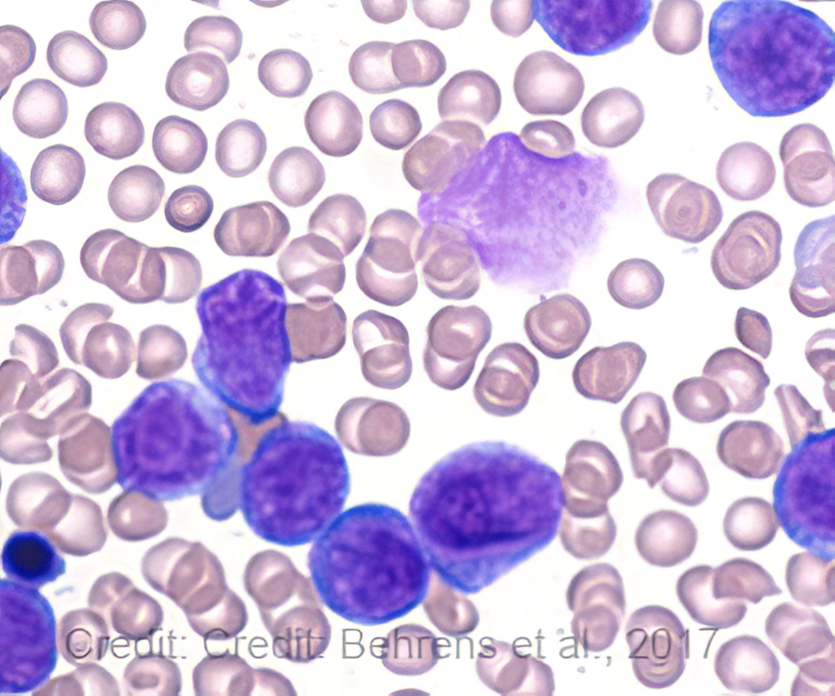 mystery-of-relapse-in-acute-myeloid-leukemia-solved