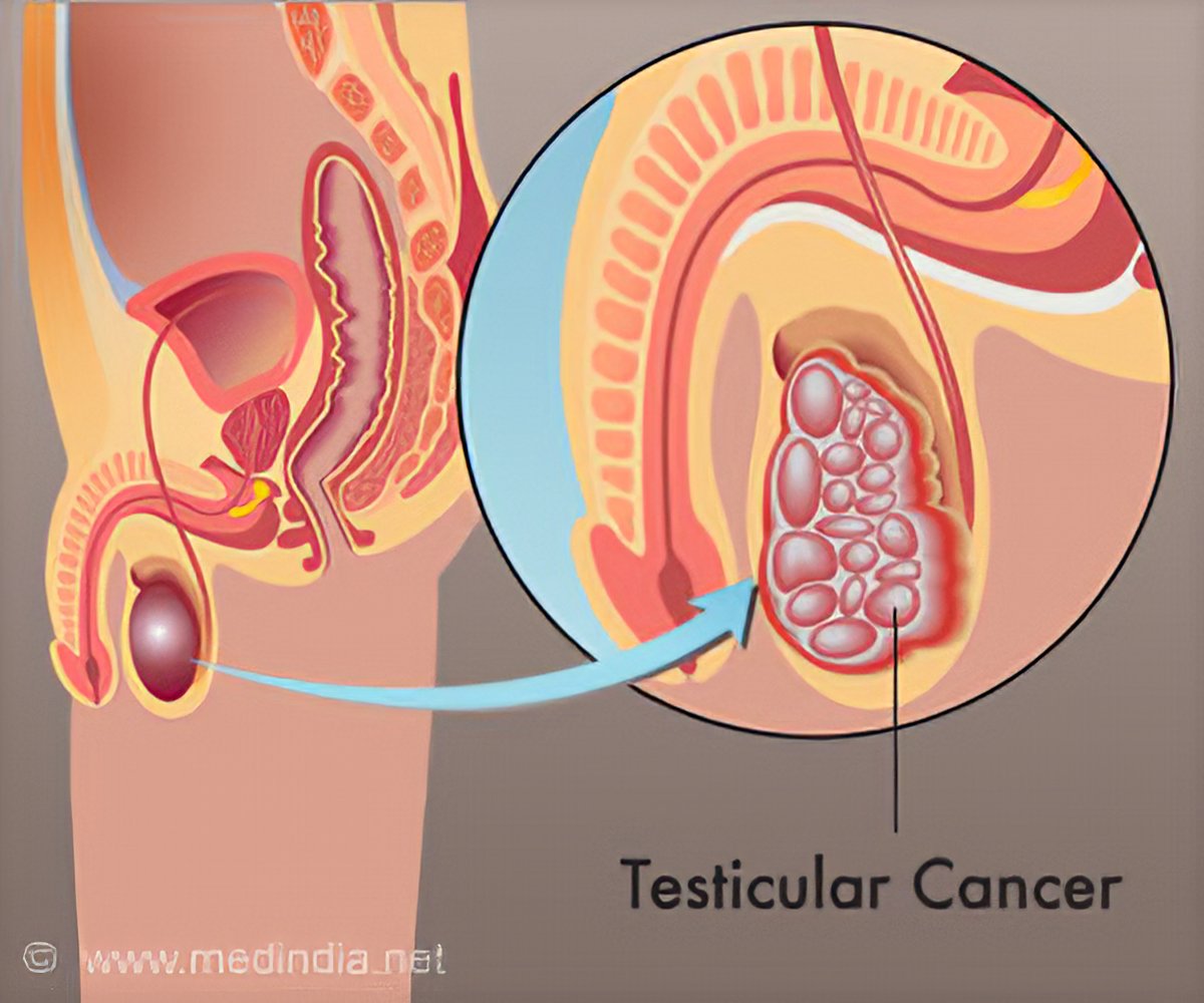 Of testicular cancer warning signs Testicular Cancer: