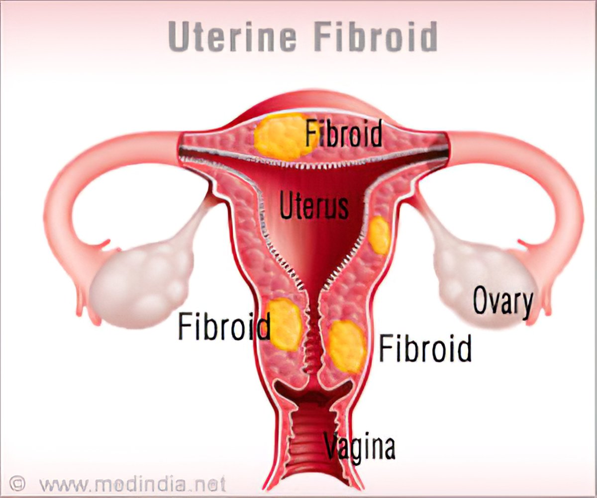 Uterine Fibroid Treatment Is Underutilized Despite Low Costs
