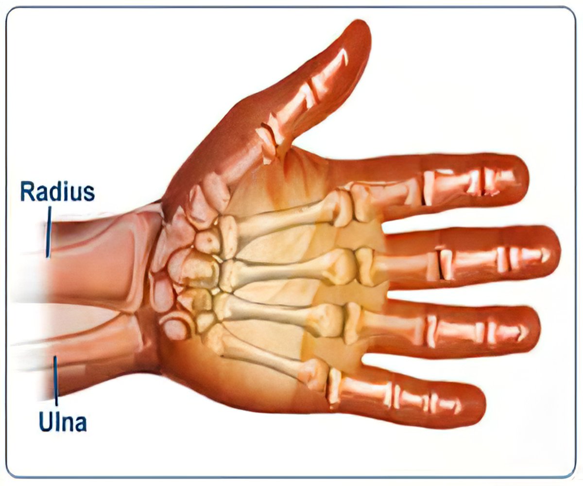 Colles wrist fracture – aftercare Information