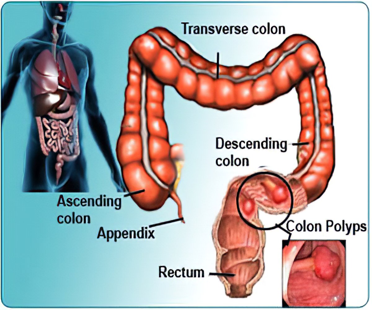 Rectal Polypectomy