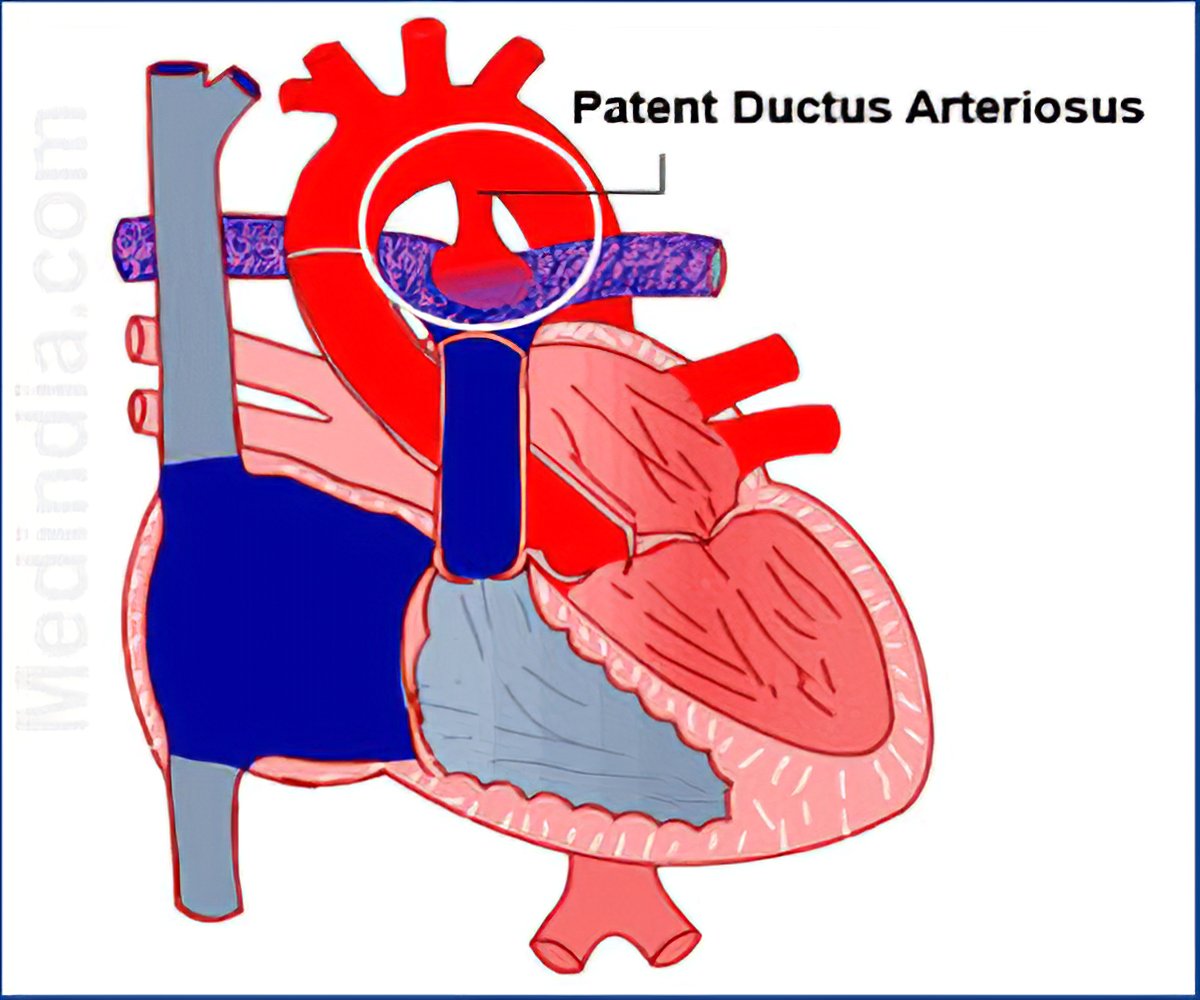 Patent Ductus Arteriosus - Normal Fetal Circulation