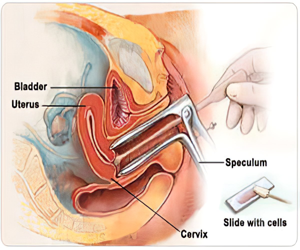 Pap Smear And Cervical Cancer Screening