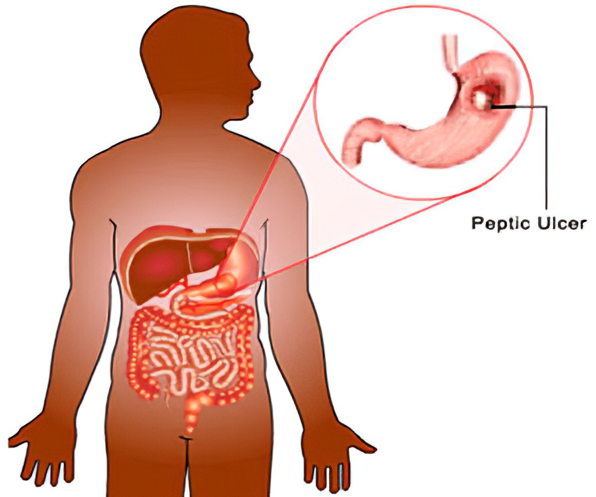 What Does Peptic Ulcer Means