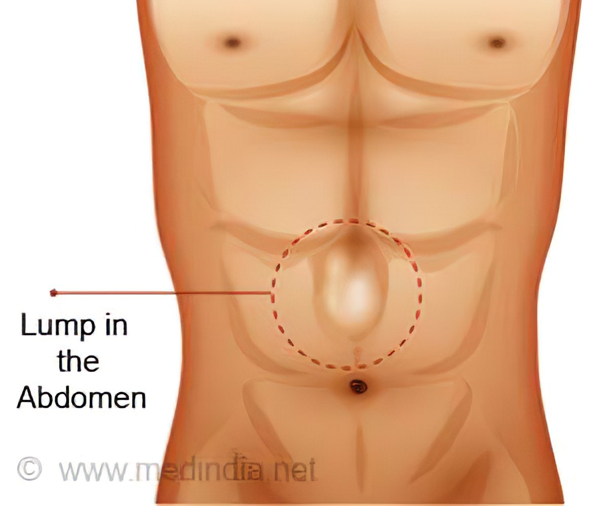 Colon cancer abdominal lump. Colon cancer abdominal mass