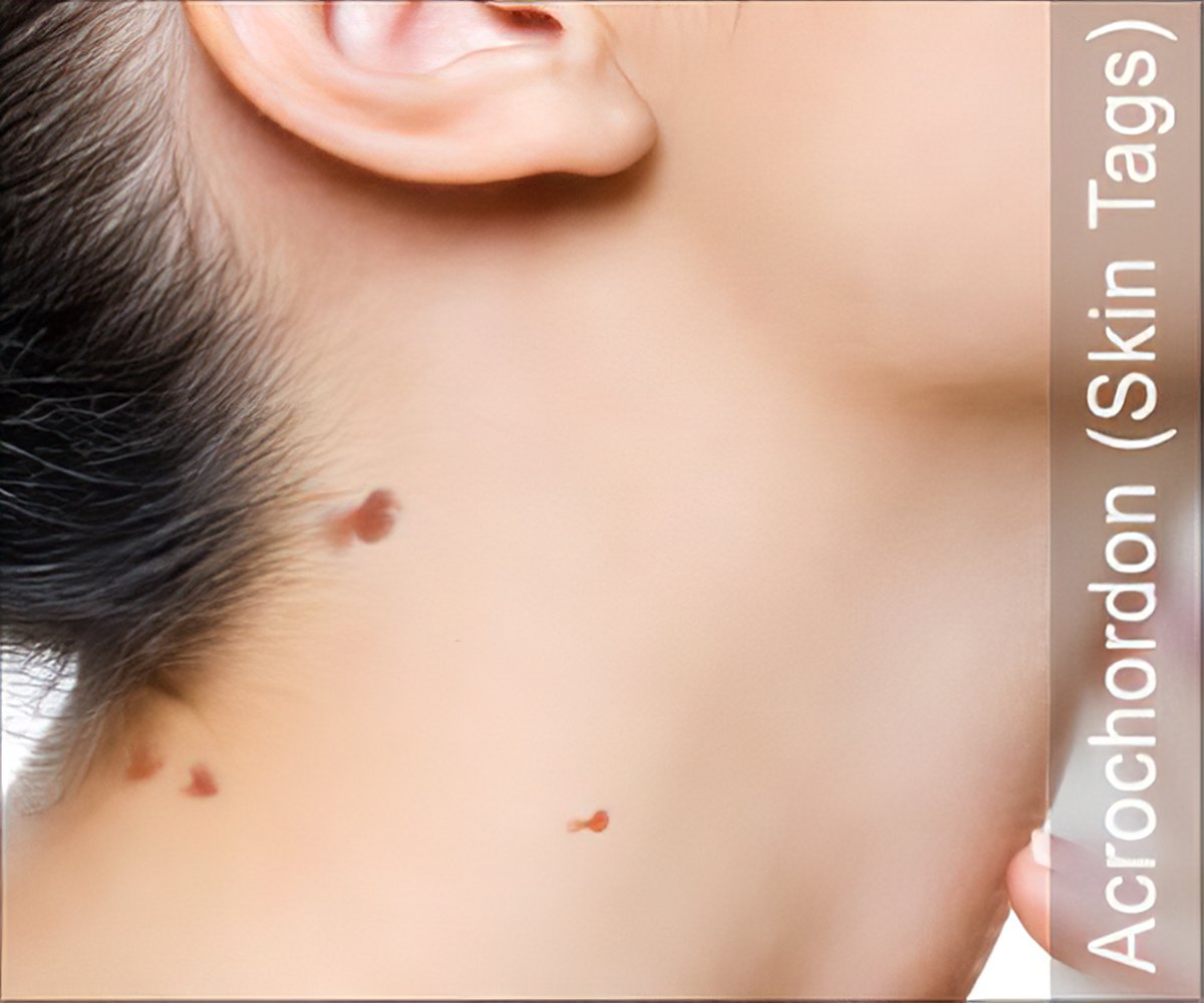 Acrochordon  Skin Tags: Causes Treatment