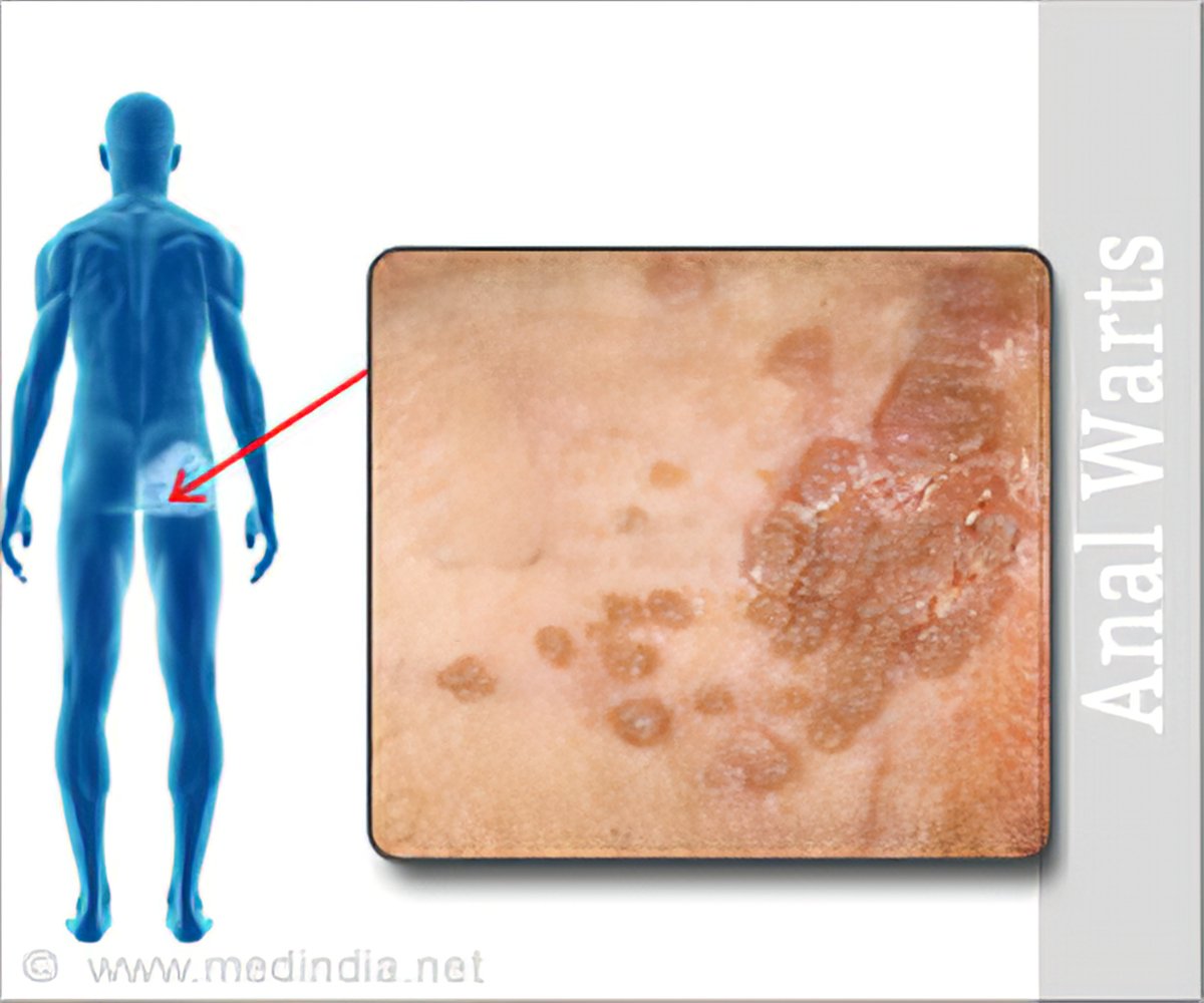 Hpv warts internal. Giardia duodenalis