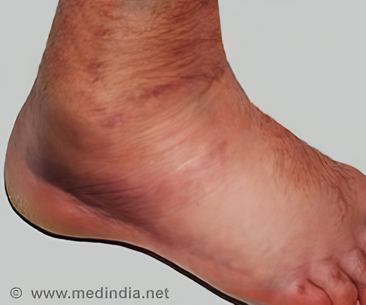 Ankle Edema Ankle Swelling Causes Faqs