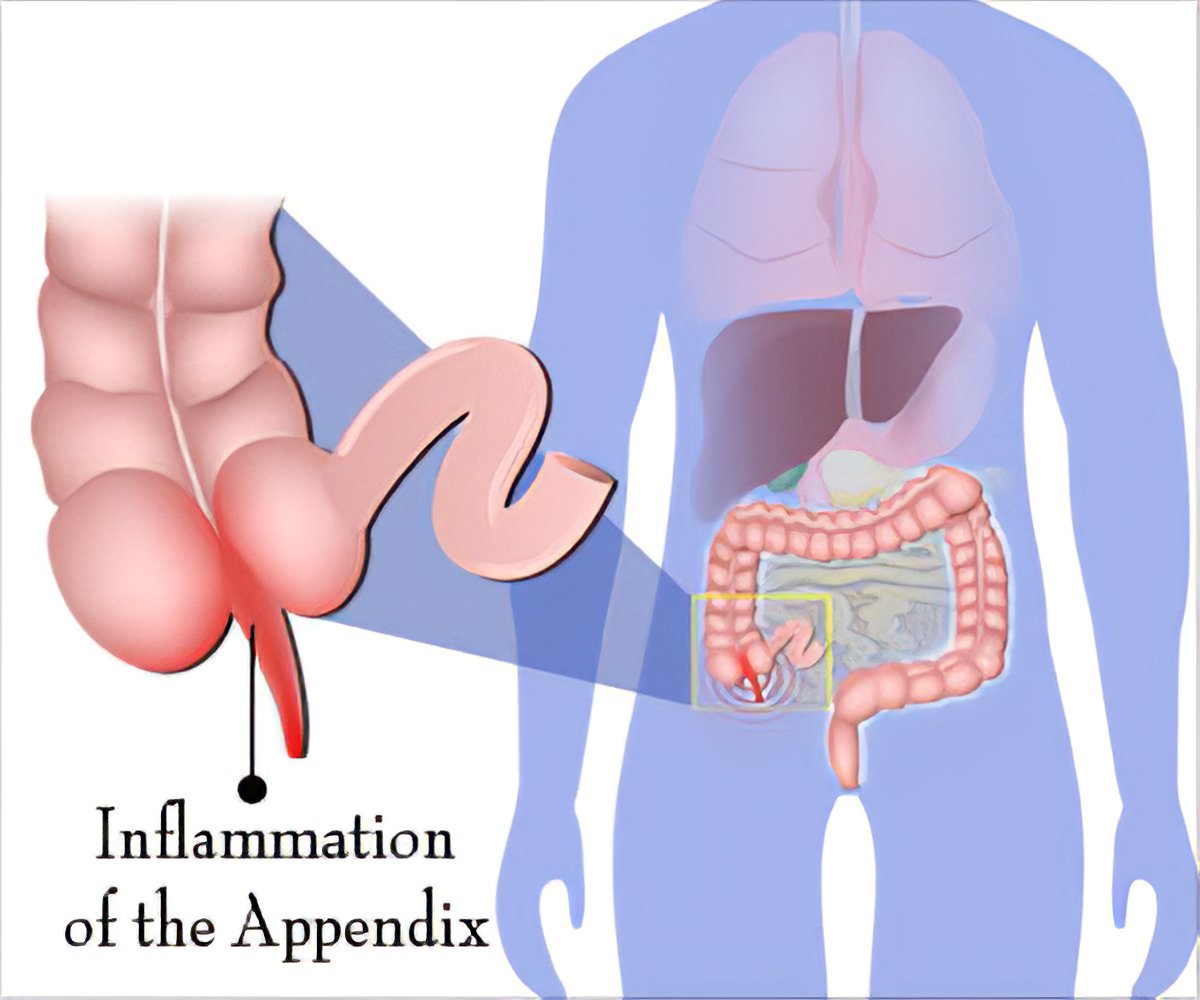 Appendicitis Appendicitis