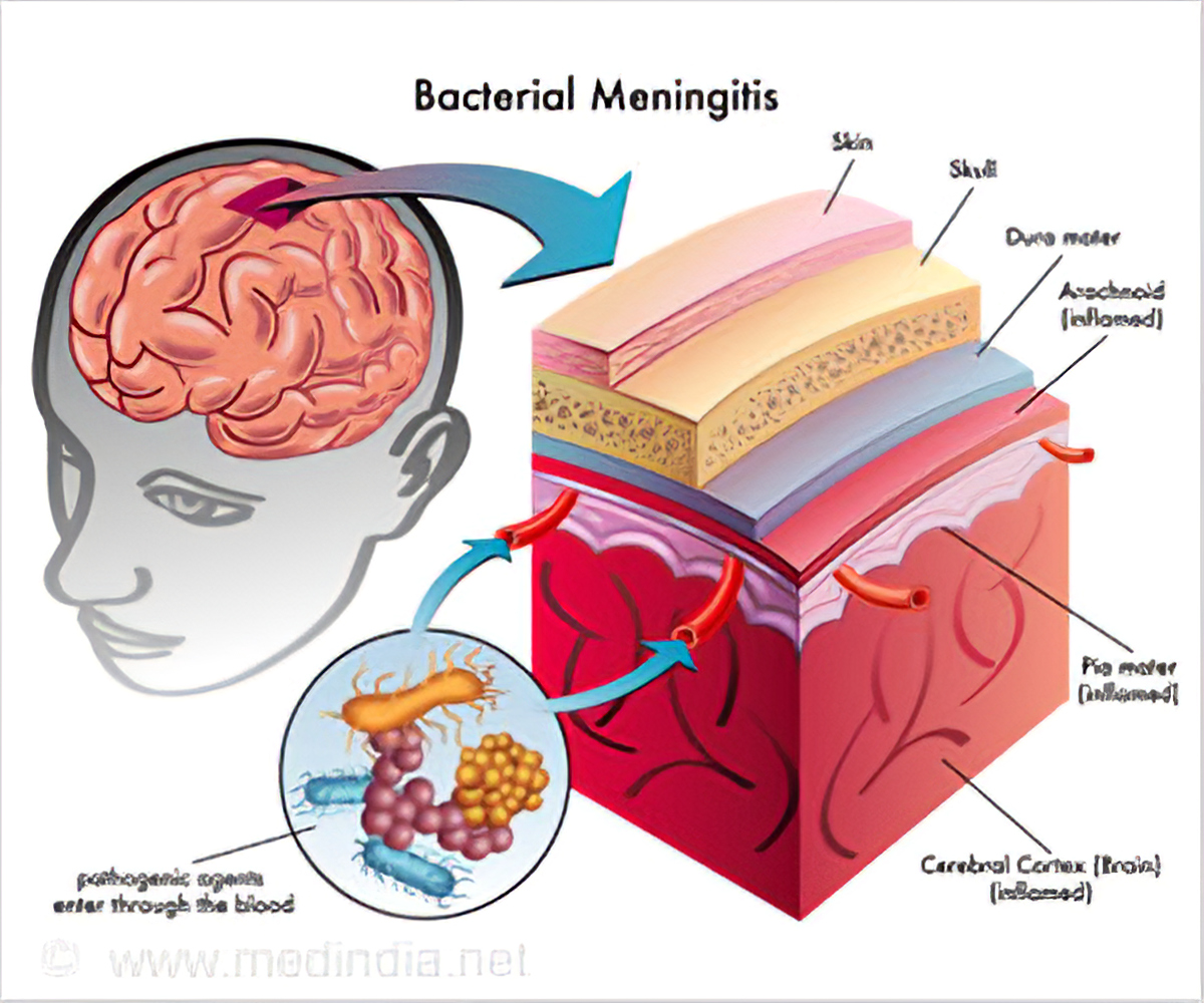 Lippe Bot M glichkeit Bacterial Meningitis Mechanism Z hmen Mitte Tastsinn