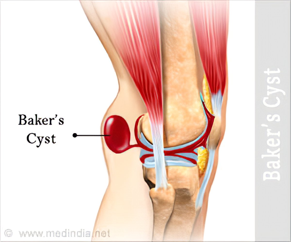 Meaning cyst Cysts Guide: