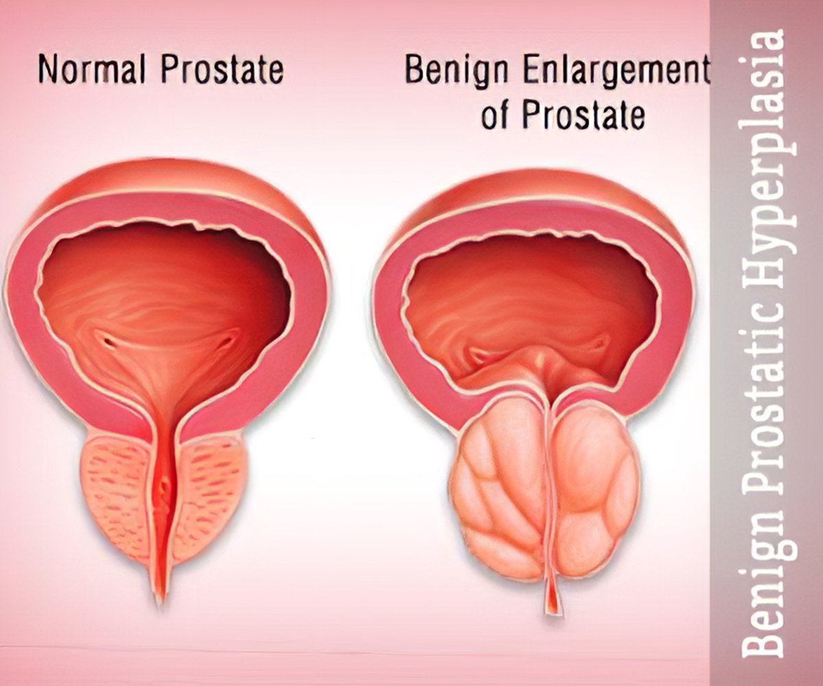 benign prostatic hyperplasia (bph) is characterized by)