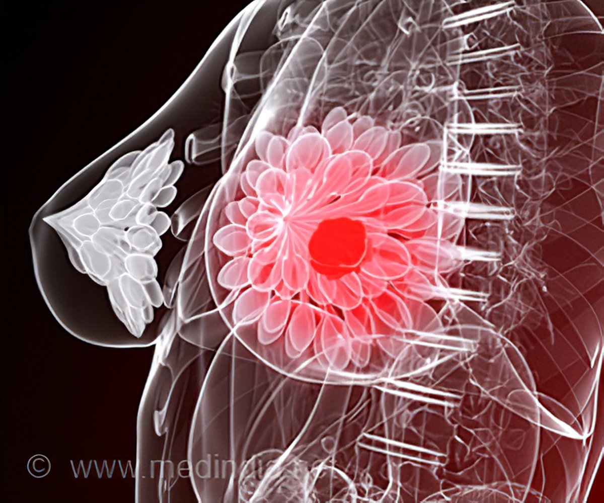Breast Cancer - Causes, Risks, Symptoms, Diagnosis, Staging, Treatment,  Prevention & Prognosis