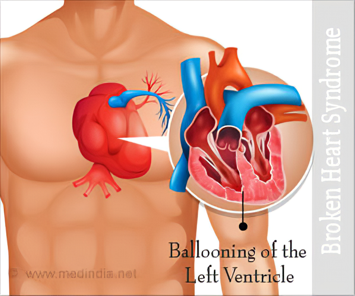 Broken Heart Syndrome  Takotsubo Syndrome (TTS) - Frequently