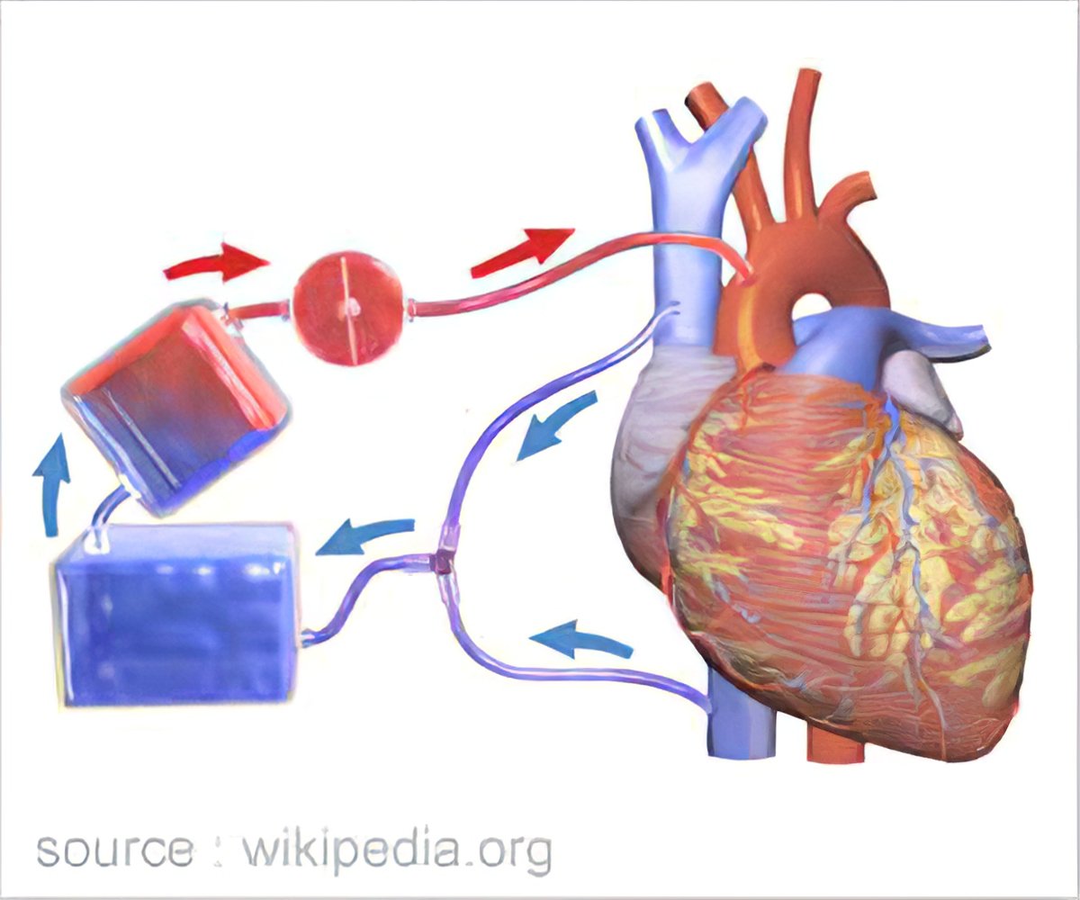 cardiopulmonary bypass diagram