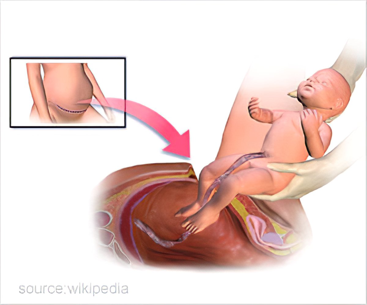 cesarean section technique with diagram