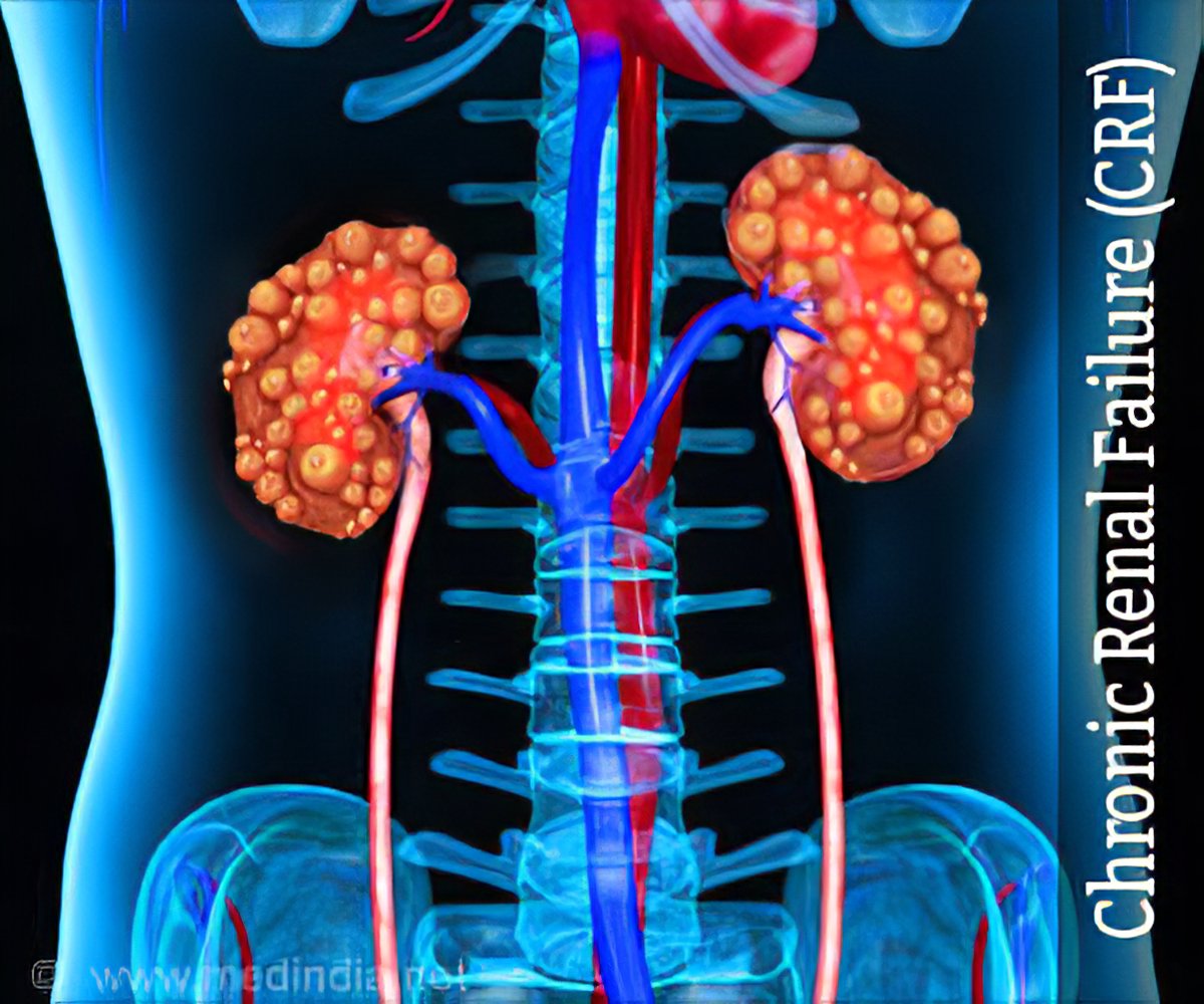 Chronic Kidney Disease (CKD) Symptoms, Causes, Treatment, 53% OFF