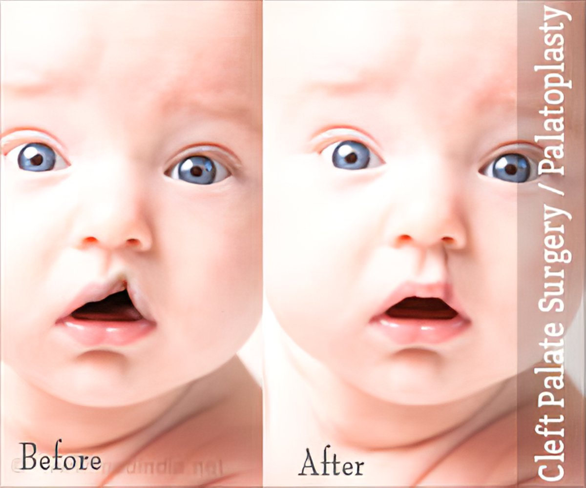 cleft lip before and after