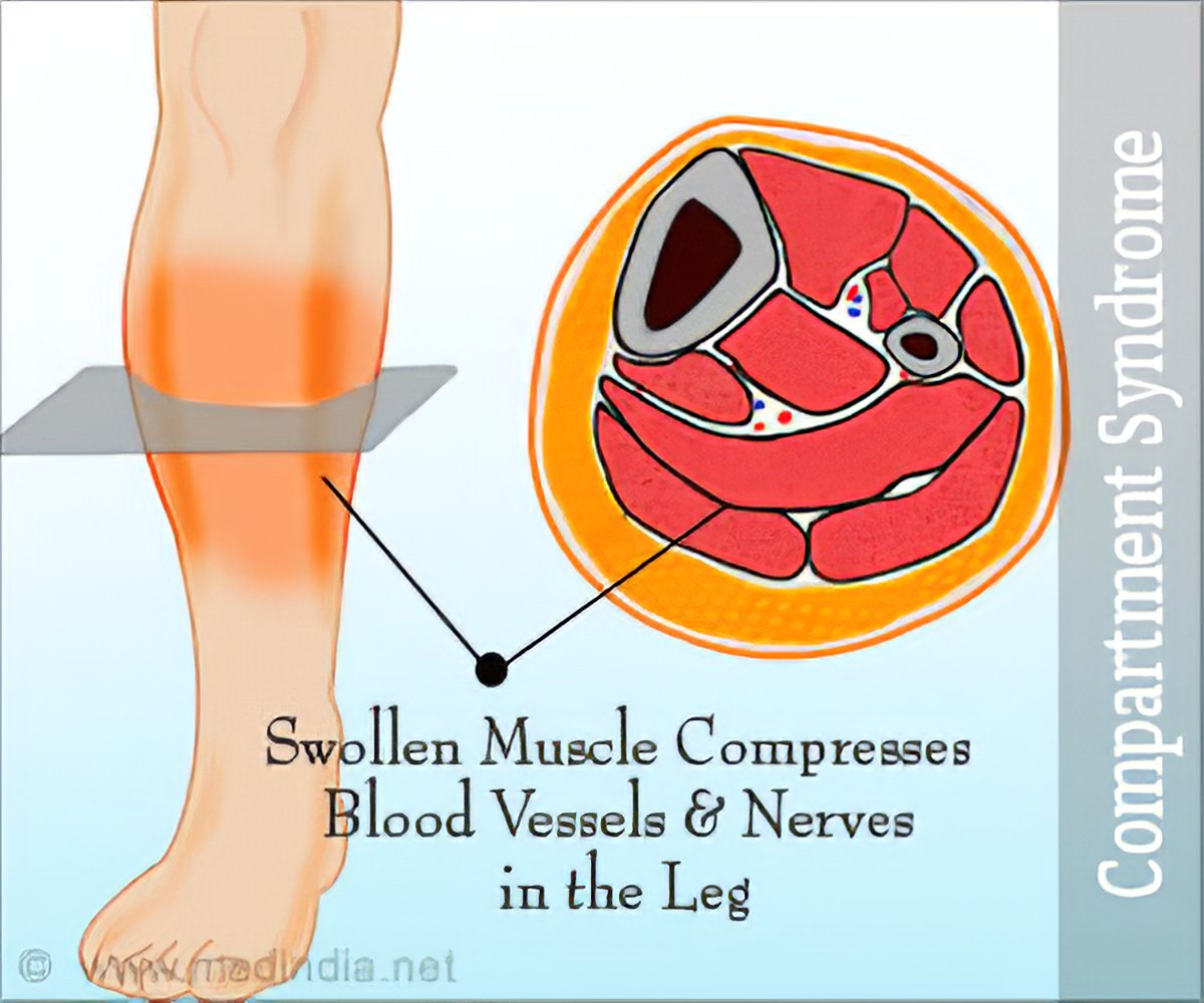 Compartment Syndrome - Types, Causes, Symptoms, Diagnosis, Treatment