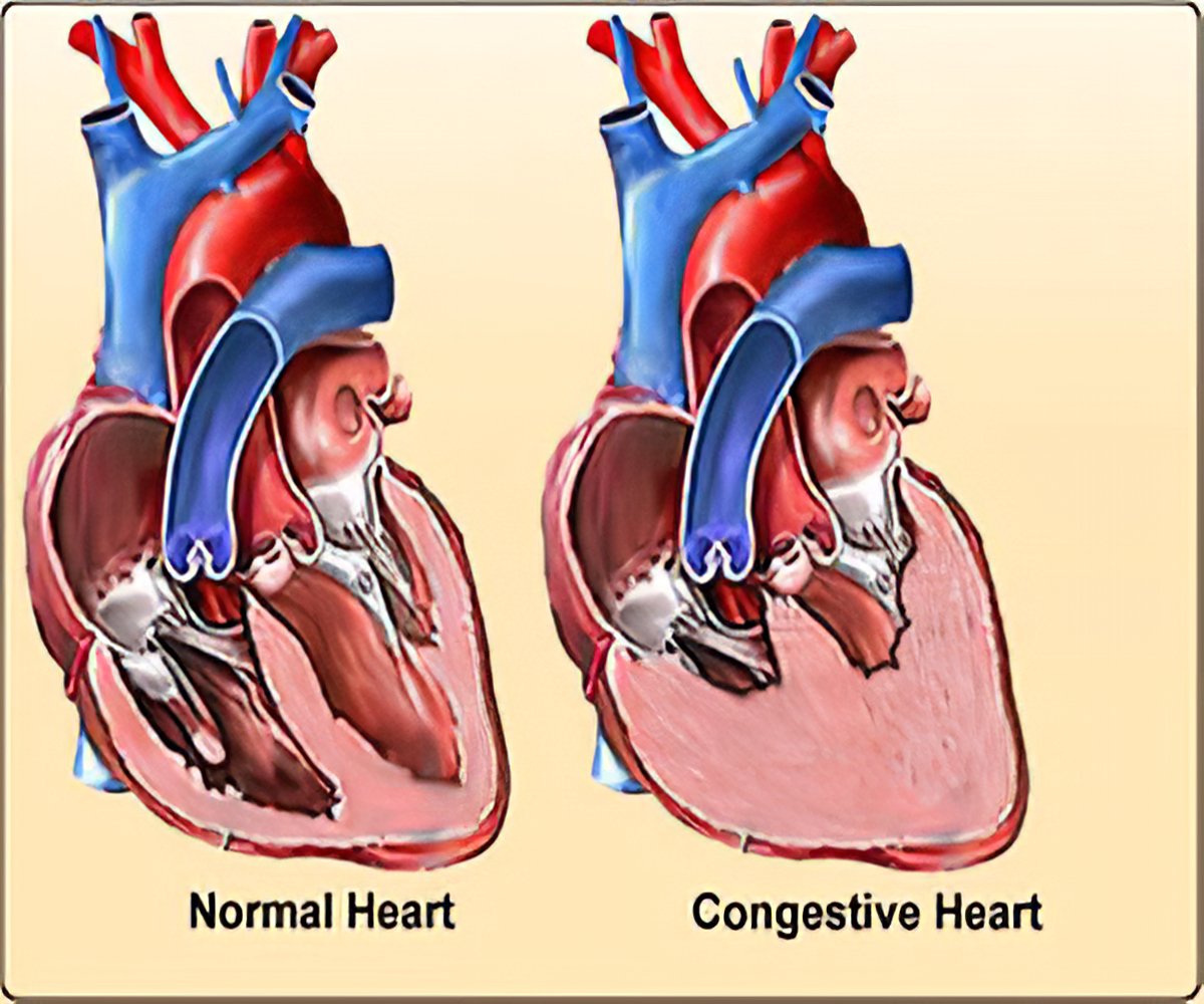 Congestive Heart Failure Congestive Cardiac Failure Current Management