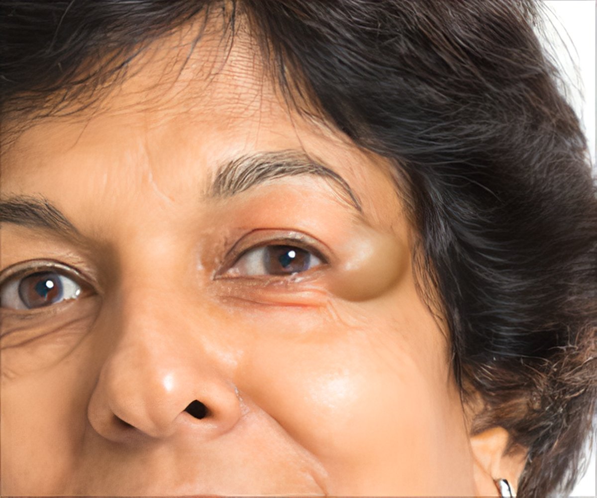 dermoid cyst eye