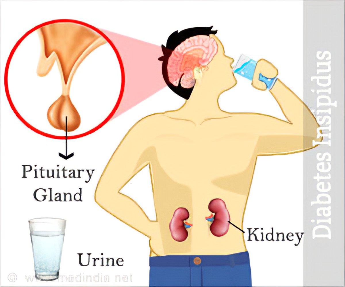 diabetes insipidus symptoms sodium