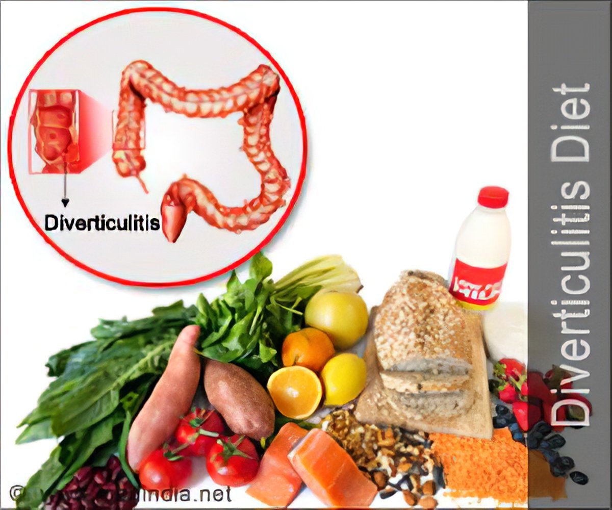 Diverticulitis Food Chart